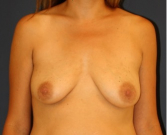 Feel Beautiful - Breast Augmentation 154 - Before Photo